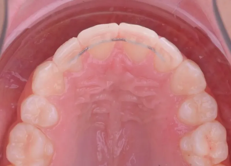 Lingual Retainer Varken Diş İpi Nasıl Kullanılır?